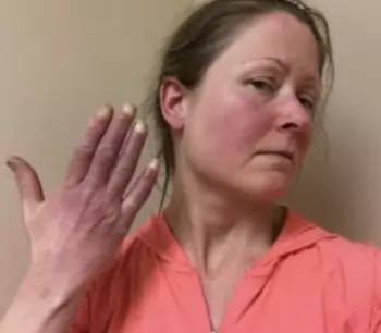Acrocianosis (manos y cara) en un paciente con síndrome de taquicardia postural ortostática