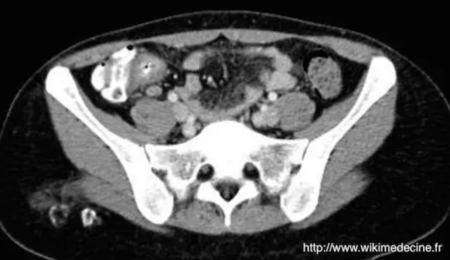 TC abdominal - Adenitis mesentérica en el contexto de una ileítis distal por Yersinia