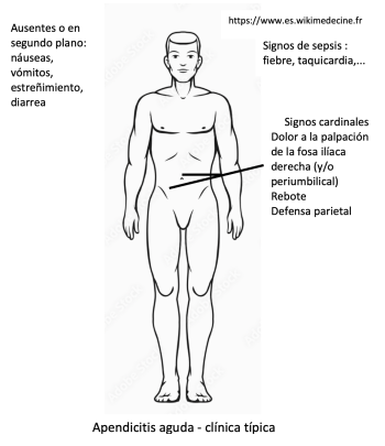 Apendicitis aguda - clínica típica