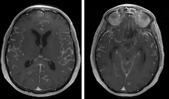 IRM - realce difuso de gadolinio - meningitis carcinomatosa