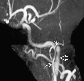 IRM - TOF - disección de una arteria carótida interna extracraneal
