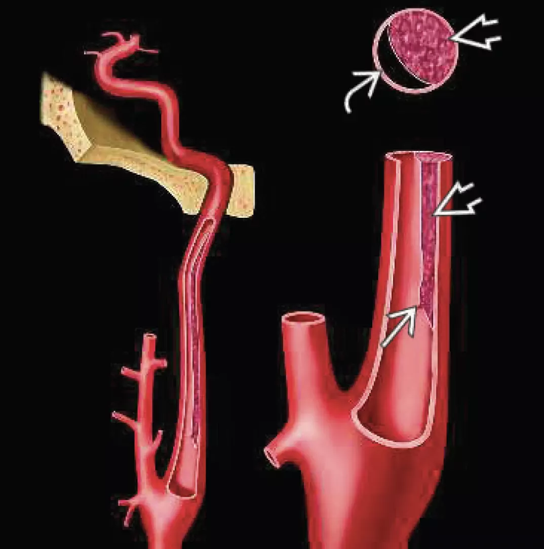 Disección extracraneal de la arteria carótida interna: rotura de la íntima, trombo subintimal, reducción de las arterias luminales