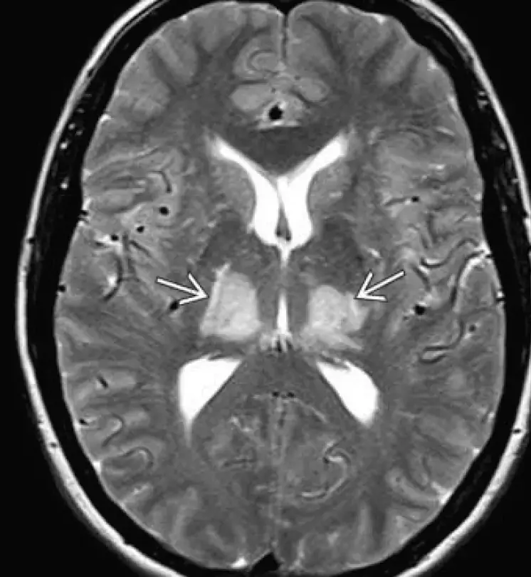 IRM T2 - encefalopatía hipertensiva con lesiones limitadas al tálamo (regresión total de las lesiones en este caso tras una bajada agresiva de la PA).