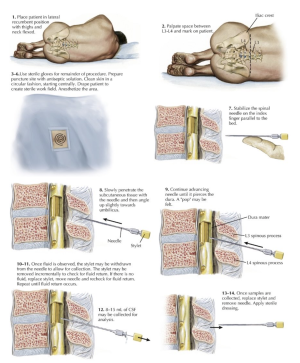 punción lumbar