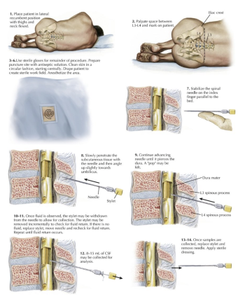 punción lumbar